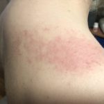 allergia al sole dermatiti